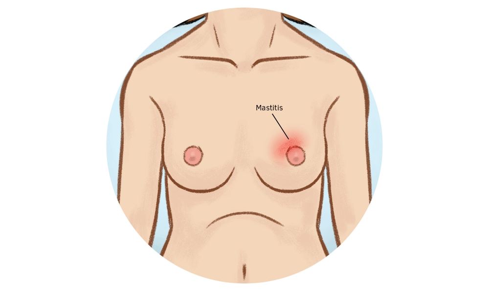 Breast Abscess