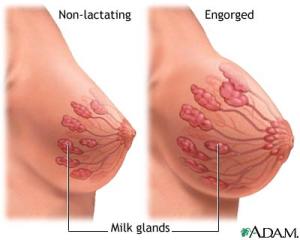 Engorgement of Breast